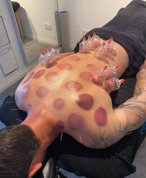 Dry Cupping Therapy