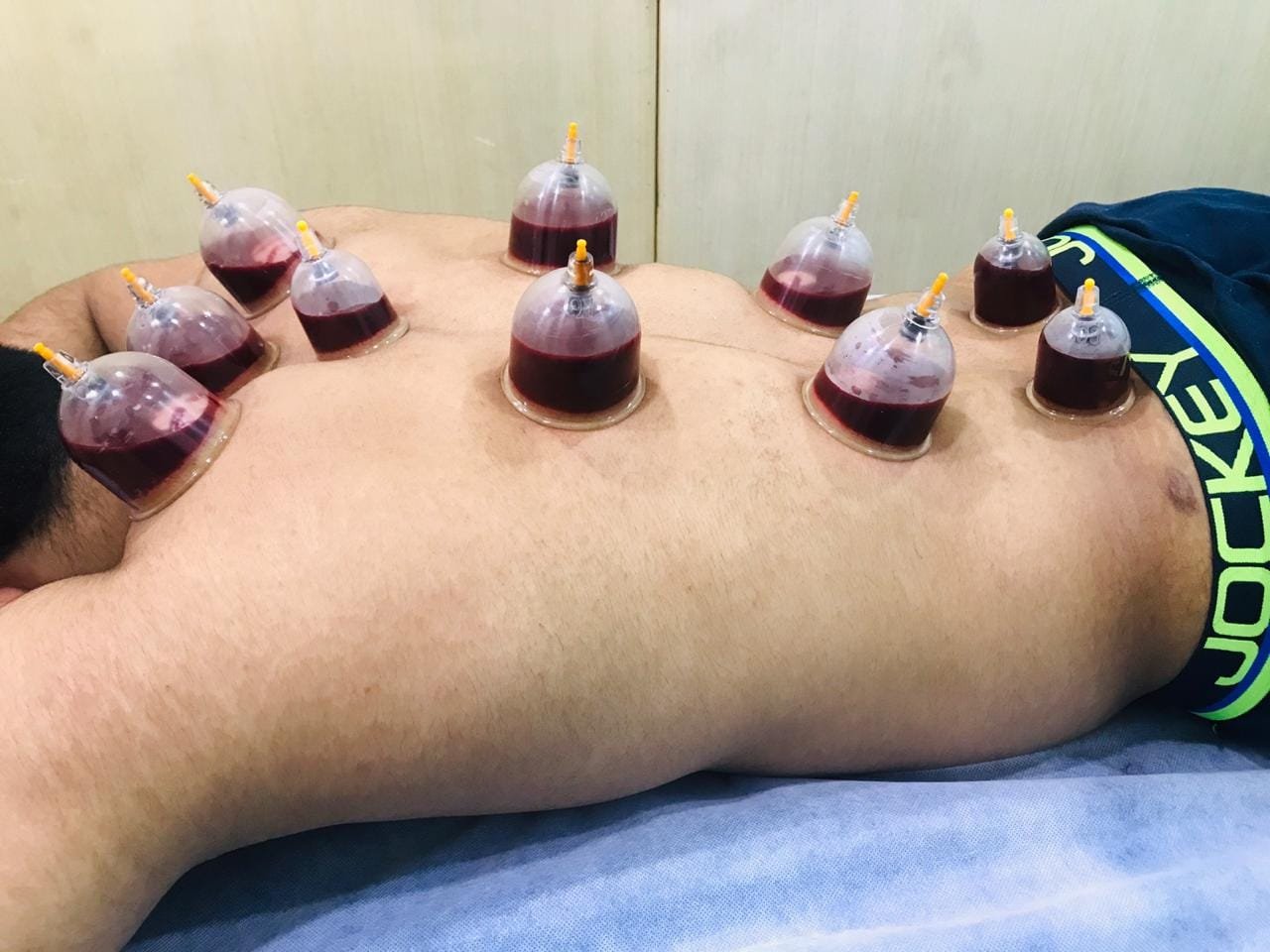 Wet Cupping Hijama